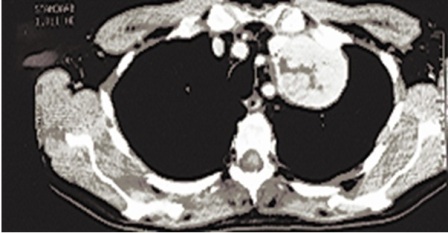 Figure 1: Chest CT scan overview - The Chest Contrast-enhanced CT scan, showed an anterior 6-cm upper left-sided mediastinal neoformation, with regular margins and not homogenous internal pattern, contiguous to the brachiocephalic trunk and the great vessels of the neck.