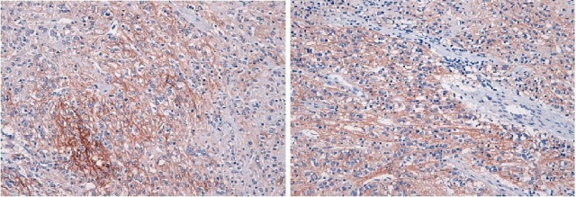 Figure 3: Mediastinal Follicular Dendritic Cell Sarcoma: Immunophenotype 20x: CD21 (a) and CD35 (b) positivity for follicular dendritic markers. 