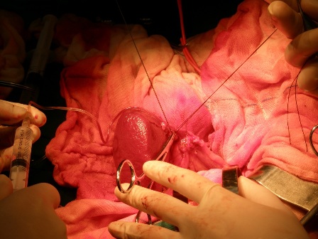 Figure 1: Selective venous sampling from the splenic vein draining different parts of the pancreas.