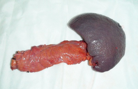 Figure 2: Resected surgical specimen