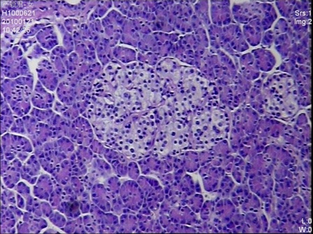 Figure 3: Multiple enlarged islets were diffusely present in the pancreatic parenchyma with variations of the size and number of cells in the islets (H&E stain, 200 x magnifications)