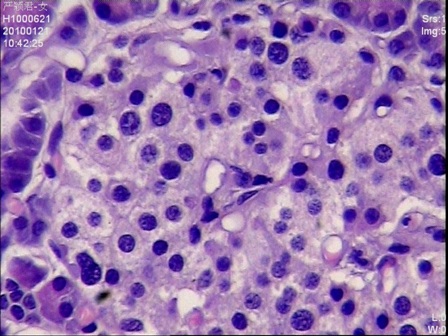 Figure 4: Islet cells with hyperchromatic nuclei and clear abundant cytoplasms (H&E stain, 400 x magnifications)