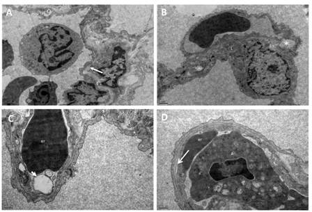 Figure 2: Electron micrographs of the lung from group II. (A) Splitting and lamellation of the basal lamina (arrow), (B) degeneration of mitochondria, and intercellular junctions of type I pneumocyte (asterix), lipid in the cytoplasm of type I pneumocyte. (C) Swelling of the endothelial cells with blebs (arrow head) (D) detachment of the endothelial cells from the basal lamina (arrow) were observed in Group II. BL: fused basal lamina, TP: thick portion of alveolar septum, er: erythrocyte, m: mitochondria, L: lipid, A: apoptotic cells. (A, B: X12 000, C, D: X25 000)