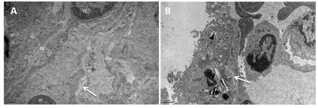 Figure 3: Electron micrographs of the lung from group IV (A), and group V (B) Lamellation and irregularity of the basal lamina (arrow). BL: fused basal lamina, TI: Type I pneumocyte, TII: Type II pneumocyte EC: endothelial cell, er: erythrocyte (A: X25 000, B: X12 000)