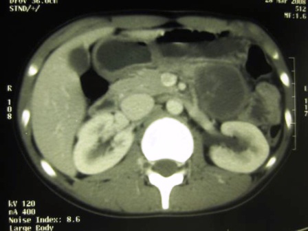 Figure 1: CT image showing a large hypodense lesion in the pancreatic tail in close apposition to the spleen