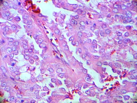 Figure2: Histology of the right lobe of the thyroid demonstrating Papillary Microcarcinoma