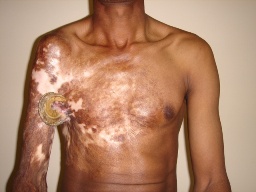 giant cutaneous horn arising from a burn scar a case report and literature review world journal of medical and surgical case reports