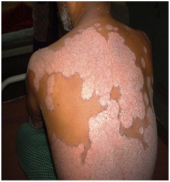 Figure-1: Patients of Chronic plaque psoriasis.