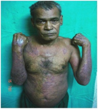 Figure-2: Patients of psoriatic erythroderma