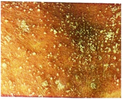 Figure-3: Pustular psoriasis.