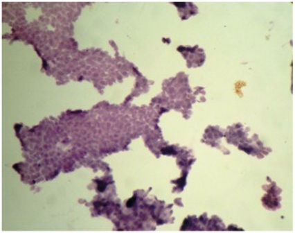 Figure-4: Photomicrograph of grade-0 changes in CIC showing (a) sheets of epithelial cells in cohesive fashion with round to oval nuclei & moderate amount of cytoplasm (PAP x 40). (b) Sheets of epithelial cells with fare number of goblet cells (pink blots) [PAS x 40].