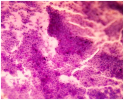 Figure-4: Photomicrograph of grade-0 changes in CIC showing (a) sheets of epithelial cells in cohesive fashion with round to oval nuclei & moderate amount of cytoplasm (PAP x 40). (b) Sheets of epithelial cells with fare number of goblet cells (pink blots) [PAS x 40].