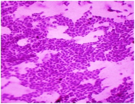 Figure-5: Photomicrograph of grade-I changes in CIC, showing (a) sheets of cells with ample amount of cytoplasm and relatively smaller nuclei size (PAP x 40); (b) sheets of epithelial cells with fair number of goblet cells (pink blots)[PAS x 40]