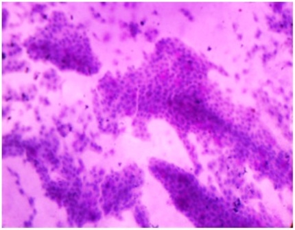 Figure-5: Photomicrograph of grade-I changes in CIC, showing (a) sheets of cells with ample amount of cytoplasm and relatively smaller nuclei size (PAP x 40); (b) sheets of epithelial cells with fair number of goblet cells (pink blots)[PAS x 40]