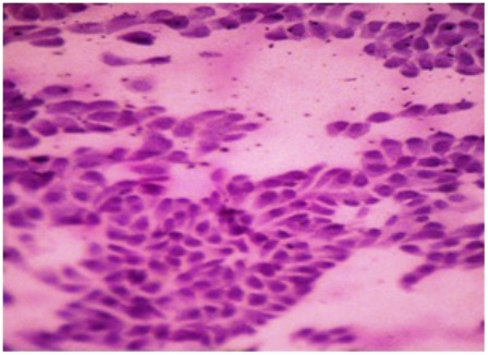 Figure-6: Photomicrograph of grade-II changes in CIC, showing (a) sheets & isolated form of cells with reduced nucleocytoplasmic ratio & focal squamous cell metaplasia (PAP x 100); (b) sheets of epithelial cells with scanty goblet cells and evidence of focal squamous metaplasia (PAS x 40).