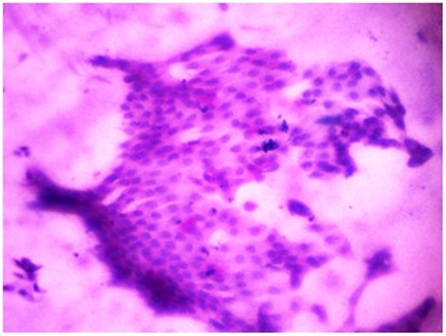 Figure-6: Photomicrograph of grade-II changes in CIC, showing (a) sheets & isolated form of cells with reduced nucleocytoplasmic ratio & focal squamous cell metaplasia (PAP x 100); (b) sheets of epithelial cells with scanty goblet cells and evidence of focal squamous metaplasia (PAS x 40).