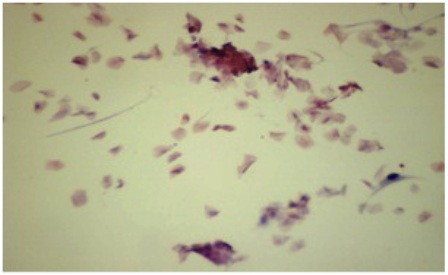 Figure-7: Photomicrograph of grade-III changes in CIC, showing (a) squamous metaplasia and very occasional clumps of cohesive epithelial cells with round to oval nuclei. (→) [PAP x 40] (b) squamous metaplasia in complete absence of goblet cells. (PAS x 100)