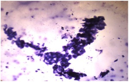 Figure-7: Photomicrograph of grade-III changes in CIC, showing (a) squamous metaplasia and very occasional clumps of cohesive epithelial cells with round to oval nuclei. (→) [PAP x 40] (b) squamous metaplasia in complete absence of goblet cells. (PAS x 100)