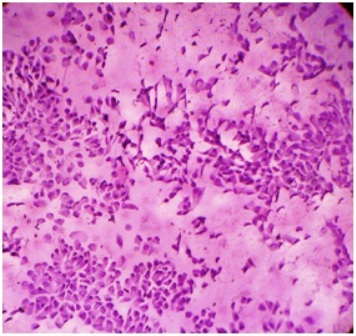 Figure-8: Photomicrograph showing (a) discohesive epithelial cells in marked mucous mixed background with endocervical like morphology (eccentrically nucleus with tall columnar like cytoplasm) [PAP x 40] (b) signet ring cell formation due to mucinous secretion in cytoplasm (→).