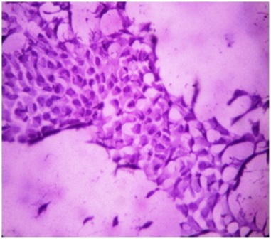 Figure-8: Photomicrograph showing (a) discohesive epithelial cells in marked mucous mixed background with endocervical like morphology (eccentrically nucleus with tall columnar like cytoplasm) [PAP x 40] (b) signet ring cell formation due to mucinous secretion in cytoplasm (→).