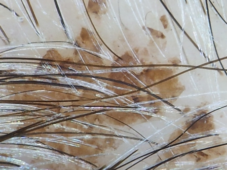 Picture 2: Dermatoscopy image of a lesion. The borders are not as irregular as initially thought