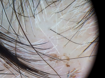 Picture 3: The lesions after rubbing the area with a small pad