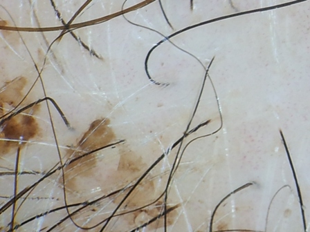 Picture 4: The lesions after rubbing the area with a small pad