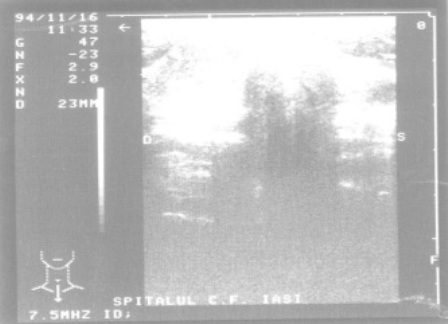 Figure 2: Ultrasound of the lateral cervical adenopathy