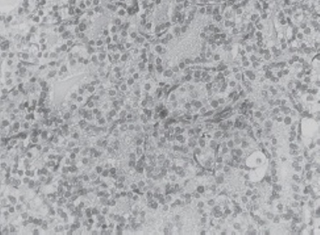 Figure 4: ITC: Histologic characteristic aspect low magnification.