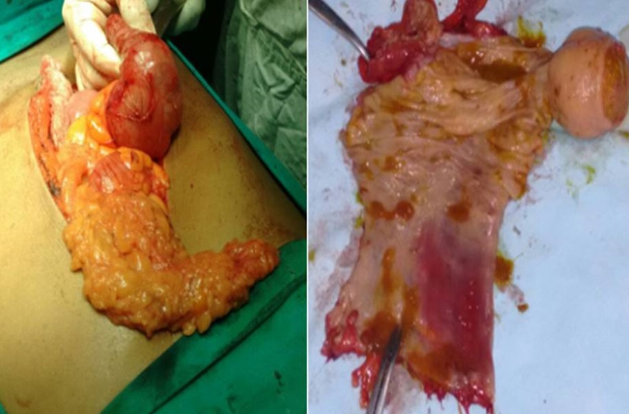 hepatic flexture resection