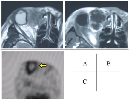 Figure 1: Mass in the inner orbit on MRI imaging and on FDG-PET/CT imaging. An ill-defined mass existed in the inner orbit. Axial T2-weighted image showed nonspecific heterogeneous intermediate intensity of right lacrimal sac with unclear margin (A). Axial post gadolinium T1-weighted image showed a peripheral margin of increased signal (B).FDG-PET/CT images showed increased uptake of FDG in the peripheral areas of the mass (arrow). The blood glucose level was 238 mg/dl in the PET/CT scanning (C).