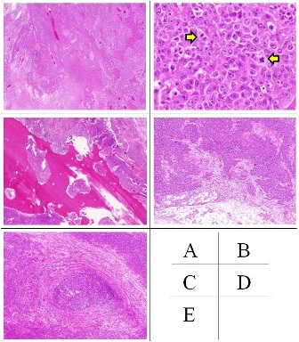 Figure 2: Pathological findings (Hematoxylin-eosin (HE) staining (A)(B)(C)(D), Victoria blue and HE compound staining (E)The pathological examination revealed no evidence of any differentiation, unclear origin of the cells, and the tumor was diagnosed as undifferentiated carcinoma of right lacrimal sac (A; HE staining, original magnification x12.5). An intermediate to high mitotic activity was recognized. (arrows, B; HE staining, original magnification x400). The tumor consisted of infiltrating bone, fat, and vessels, but was separated from the eye globe (C; HE staining, original magnification x20, D; HE staining, original magnification x20, E; Victoria blue and HE staining, original magnification x40). There was no evidence of ocular invasion