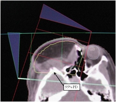 Figure 3: Dose distribution of postoperative radiotherapy The solid line of postoperative site shows a 95% prescribed isodose line (arrow). The line well covered the postoperative site where the tumor had been resected.