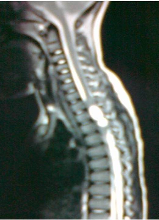 Fig.1: Intra-Medullary lesion in upper Dorsal MRI T2 weighted