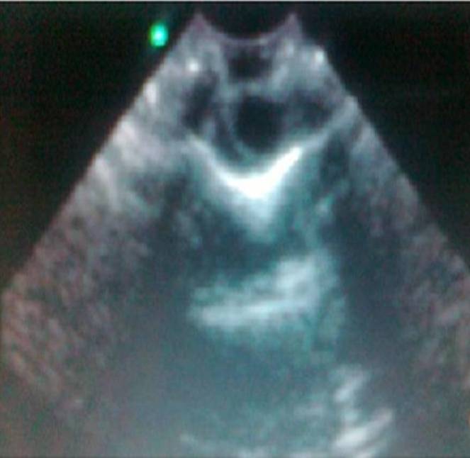 Fig.2: Intraoperative ultrasound showing the hypoechoic area in the cord of Fig 1 lesion