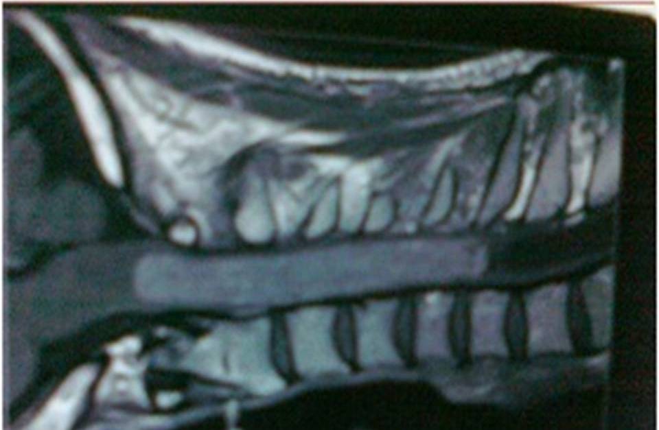 Fig.3: Intramedullary  cervical Space occupying lesion in MRI