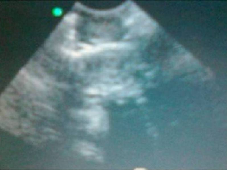 Fig.4: Intraoperative ultrasound showing hyperechoeic picture inside cord of lesion of Fig 3