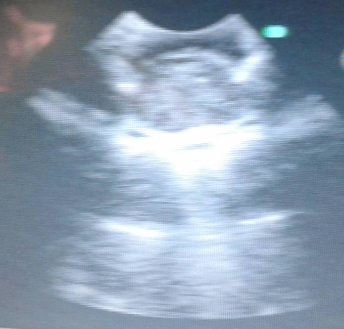 Fig.6: Lesion seen through intraoperative ultrasound as in Fig 5