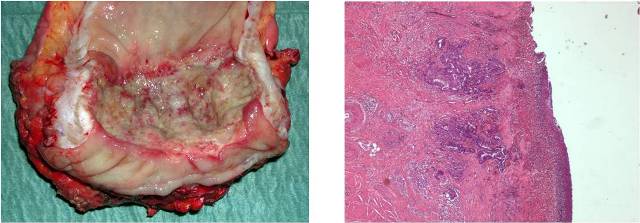 Image 1: Histology: Adenocarcinoma mildly differenziated (G2), extensively ulcerated, infiltrating bowel's wall until to peri visceral's tissues, with large aspects of regression and fibrosis.