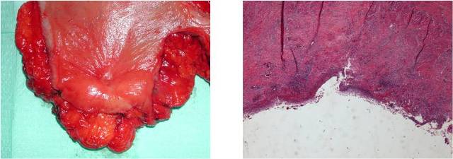 Image 2: Histology: Ulcerated area of mucosal on an sclerosis area trans mural, focally seat of chronic inflammation granulomatous giant. Bowel wall surrounding submucosal fibrosis and hypertrophy of the muscularis mucosal. Neoplastic tissue not reperted.